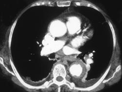 Intramural Hematoma - CTisus CT Scan