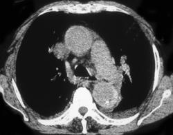 Intramural Hematoma (c-/c+) - CTisus CT Scan