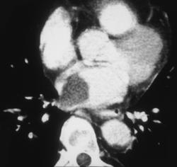 Thyroid Cancer Metastases Grow Into Left Atrium - CTisus CT Scan