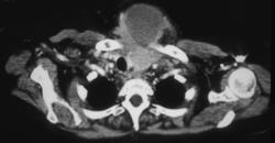 Thyroid Cancer With Nodes - CTisus CT Scan