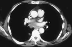 Lymphoma - CTisus CT Scan