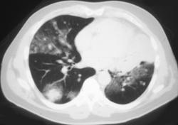 Hemorrhagic Metastases From Renal Carcinoma - CTisus CT Scan