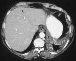 Metastases Colon Cancer to Pleura - CTisus CT Scan