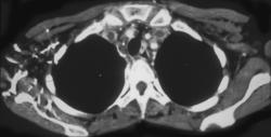 Innominate and SVC Clot - CTisus CT Scan