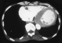 Thickened Wall of the Left Ventricle - CTisus CT Scan