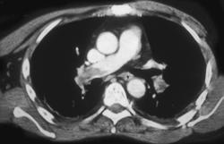 Pe - CTisus CT Scan