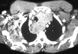 Substernal Thyroid Involving Posterior Mediastinum - CTisus CT Scan