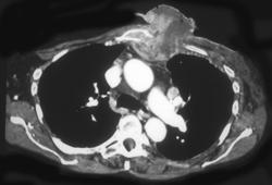 Recurrent Breast Cancer Grows Through the Chest Wall - CTisus CT Scan