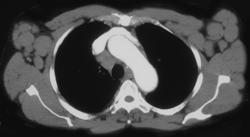 Lymphoma With Axillary and Mediastinal Nodes - CTisus CT Scan