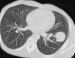 Pulmonary Arteriovenous Malformation (AVM) - CTisus CT Scan