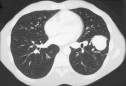 Pulmonary Arteriovenous Malformation (PAVM) - CTisus CT Scan