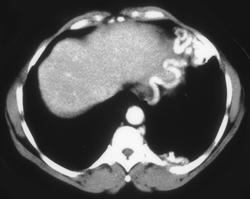 Pulmonary Arteriovenous Malformation (PAVM) - CTisus CT Scan