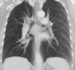 Normal Airway - CTisus CT Scan