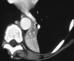 Left Lower Atelectasis - CTisus CT Scan