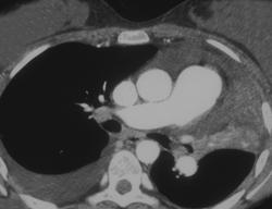 Left Upper Lobe Atelectasis - CTisus CT Scan