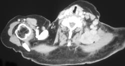 Enhancing Supraclavicular Nodes - CTisus CT Scan