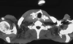 SVC Occlusion Extends Into Jugular Vein - CTisus CT Scan