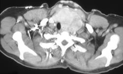 Substernal Thyroid - CTisus CT Scan