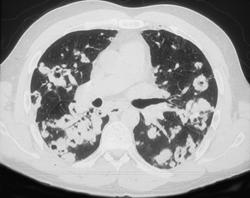 Cavitary Metastases - CTisus CT Scan