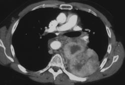 Neurofibrosarcoma - CTisus CT Scan