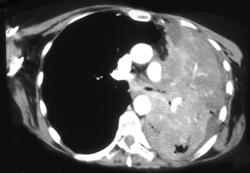 Bronchoalveolar Cell Cancer - CTisus CT Scan