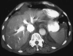 Right Heart Failure - CTisus CT Scan