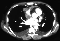 SVC Clot - CTisus CT Scan