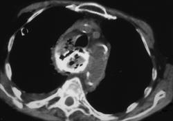 Perforated Esophagus - CTisus CT Scan