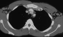 Lymphoma - CTisus CT Scan