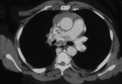 SVC Occlusion Due to Histoplasmosis - CTisus CT Scan