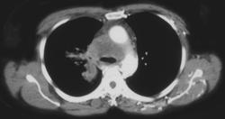 SVC Occlusion With Collaterals - CTisus CT Scan