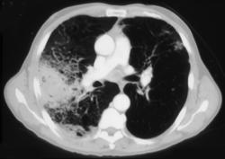 Pulmonary Hemorrhage Due to Pseudoaneurysm - CTisus CT Scan