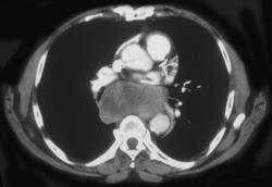 Neuroblastoma - CTisus CT Scan