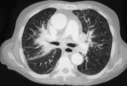 Lymphangitic Spread of Tumor - CTisus CT Scan