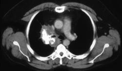 Metastatic Osteosarcoma - CTisus CT Scan