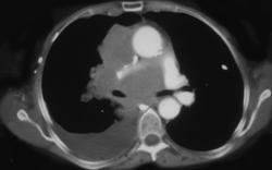 Lymphoma - CTisus CT Scan