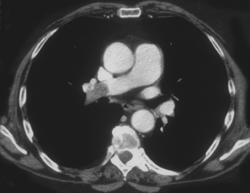 Pulmonary Embolism - CTisus CT Scan