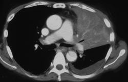 Left Upper Lung Collapse - CTisus CT Scan