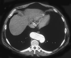 Aortic Dissection - CTisus CT Scan