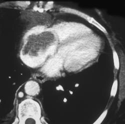 Lymphoma- Primary to Heart - CTisus CT Scan