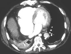 Right Sided Heart Failure - CTisus CT Scan