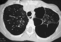 Blebs - CTisus CT Scan