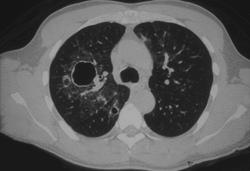 Cystic Fibrosis - CTisus CT Scan