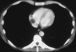 Clot Due to Catheter in SVC - CTisus CT Scan