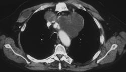 Melanoma Involving the Heart - CTisus CT Scan