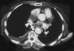 SVC Thrombosis - CTisus CT Scan