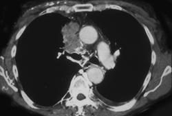 SVC Occlusion With Collaterals - CTisus CT Scan