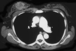 Breast Cancer - CTisus CT Scan