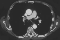 Pulmonary Embolism - CTisus CT Scan