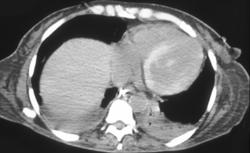 Oxalosis - CTisus CT Scan